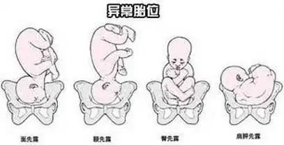 4种胎位致孕妇易难产