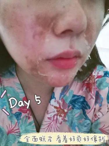 分享一下我滴刷酸七天情况给大家参考参考