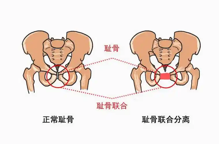 耻骨在哪个位置的图片 孕妇(耻骨在哪个位置的图片 孕妇孕中期耻骨疼)
