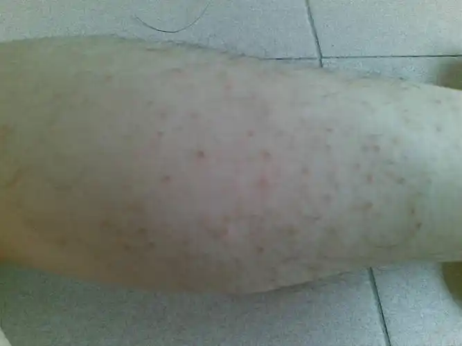 小腿肚子长了很多灰色斑点