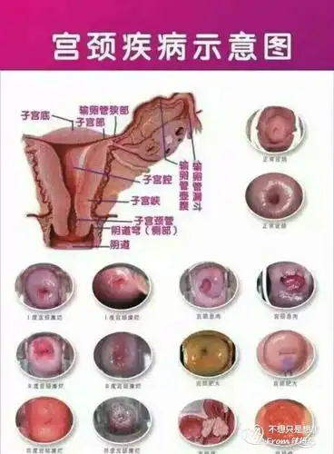 宫颈炎宫颈糜烂三度严重吗要怎样治疗(宫颈糜烂三度怎样引起的),不想
