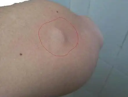 脂肪肉瘤与脂肪瘤区别相关文章