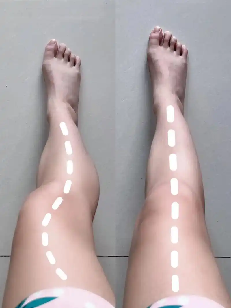 xo型腿,走路容易脚痛,小腿外翻的都可以用,坚持穿腿型会越来越好!