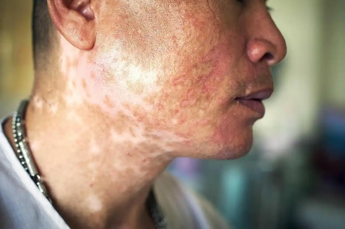 广州去哪家医院看白癜风# #白斑初期症状图片#   为什么成年人的