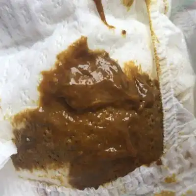 我家宝宝三个半月,最近老是拉绿色大便粘糊糊的还拉丝,两天左右拉一次