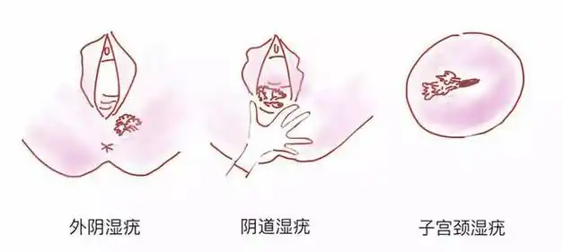 济南青华医院:尖锐湿疣的初期症状是什么?_部位_生物_生殖器