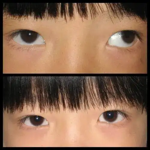 斜视手术的目的不仅仅是为了改善外观丨南阳医专一附院|弱视|治疗