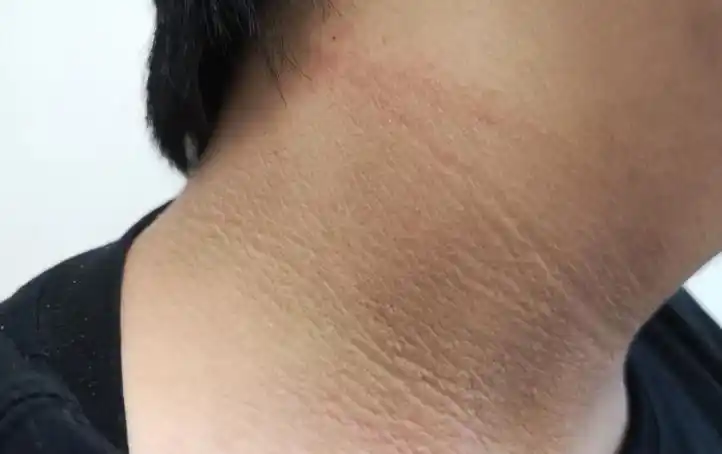 表现|速自查!脖子上出现这个东西,可能是糖尿病的表现