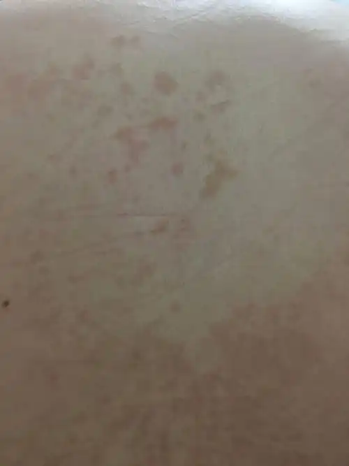 会不会扩散?求医生告知,在线等,急