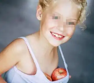 性早熟:医学上是指没到发育年龄时就出现性发育,女孩8周岁以前乳房