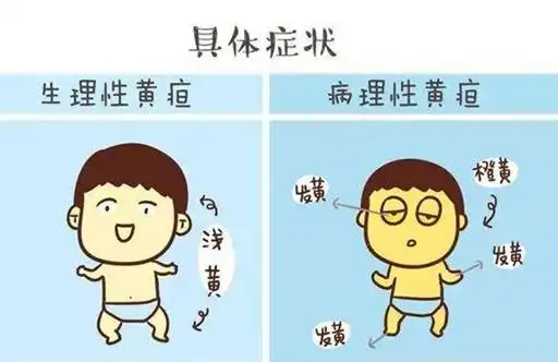 黄疸图片对比照 新生儿黄疸图片症状