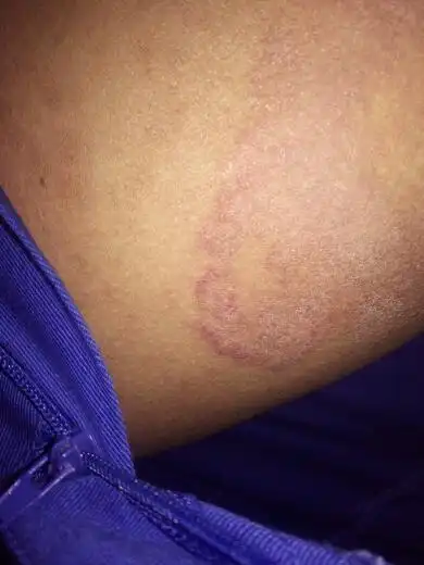 这是在大腿内侧,前段时间很痒,就用手抓,就形成一个圈的状态,就用之痒