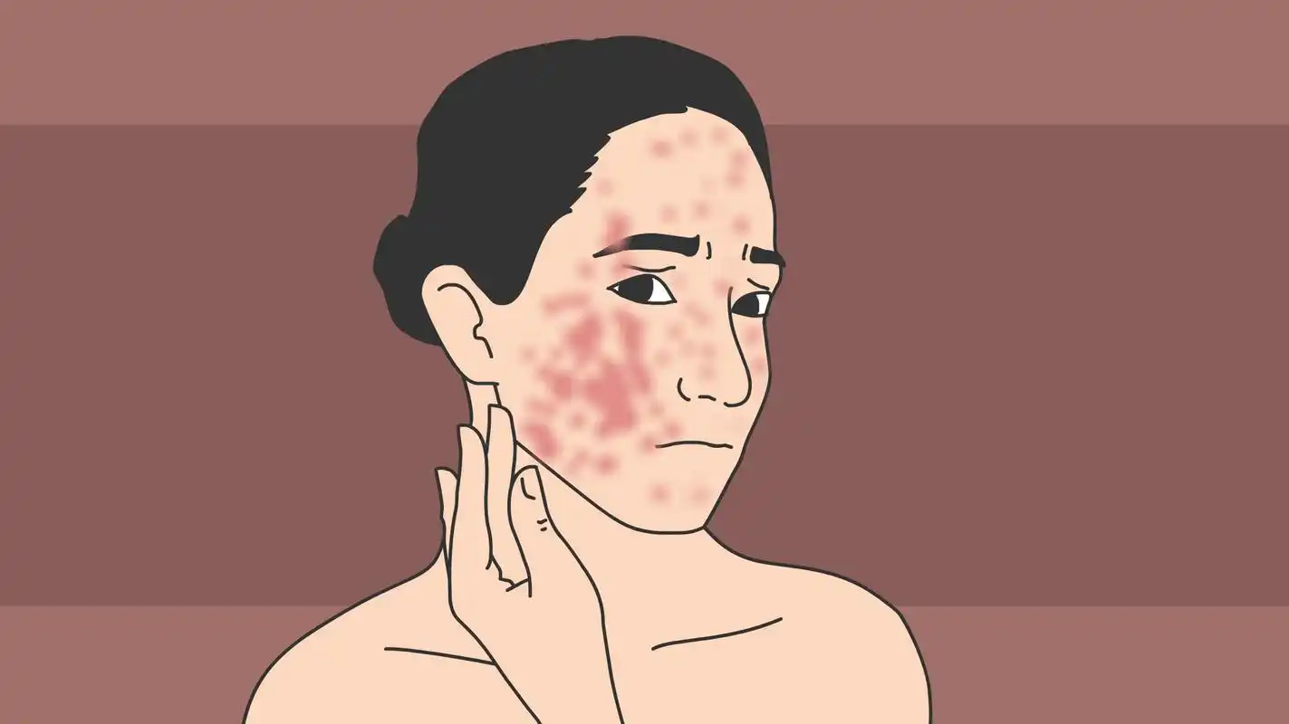 南京看皮炎好的医院#  症状 :皮肤出现明显鲜红色斑,表面光滑,变薄