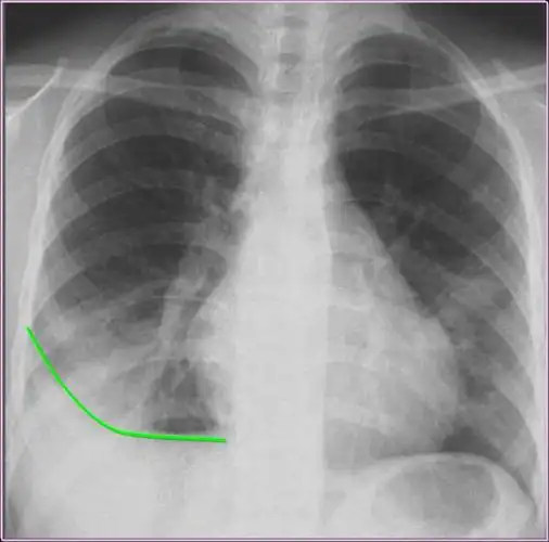 游离性胸腔积液: (1)少量积液:首先在侧位胸片上显示后肋膈角变钝.