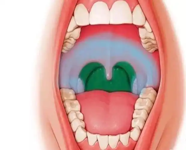 是在咽峡部出现疱疹,通常先发热1-3天左右,出现疱疹,孩子出现