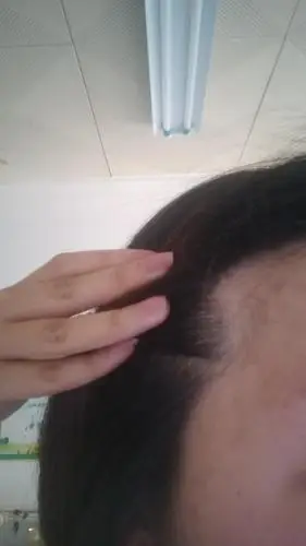 姐妹们这是秃头吗?我的发际线怎么这么奇怪