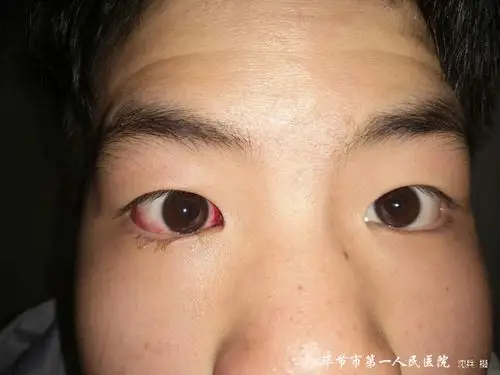 毕节市第一人民医院眼科为一名15岁的重度弱视和右眼斜视男性患者手术