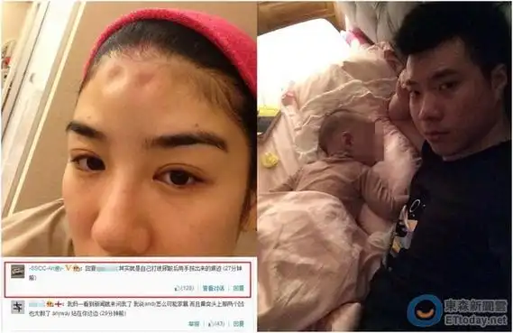 黄奕称被家暴头部凹陷 老公:打玻尿酸手按的(图)