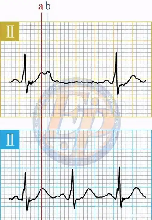 心电图基础:认识房性期前收缩(房性早搏)