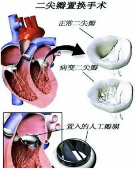 心脏的心门被撬开细讲二尖瓣关闭不全那些事儿