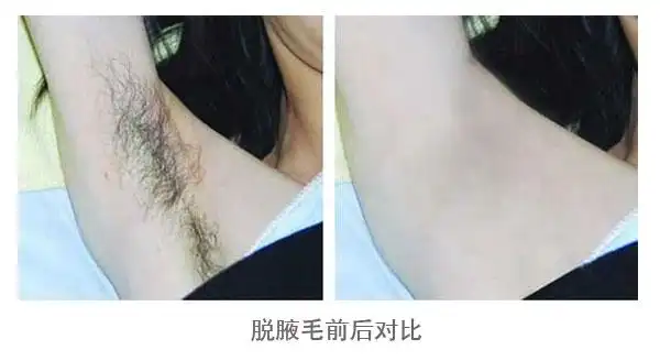桂林腋下冰点脱毛的效果如何