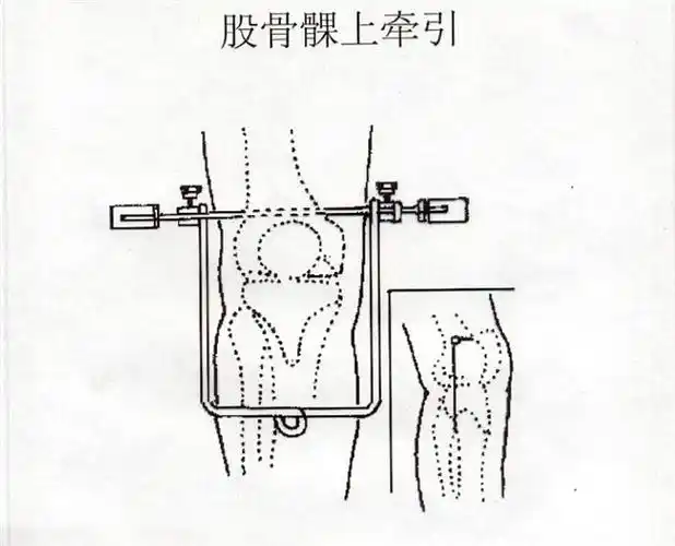 股骨髁上牵引