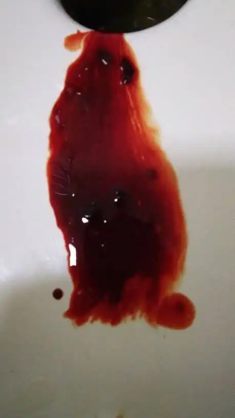 你好,我一直以来都是经期前腹部左侧疼,仔细的摸一