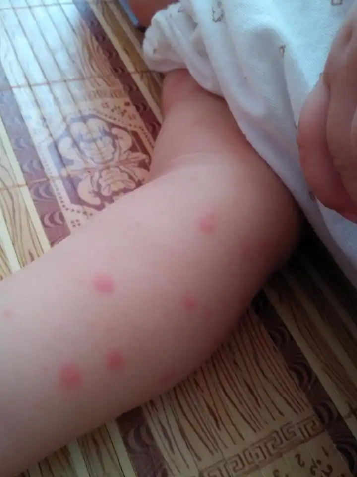 天气太热,宝宝手上突然出现好多小红点,有什么药擦吗?_百度宝宝知道