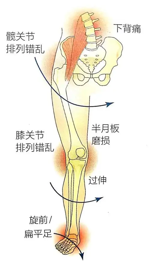脚内侧疼,不要忽视!下肢运动损伤综合征:小疼痛可能引起大问题