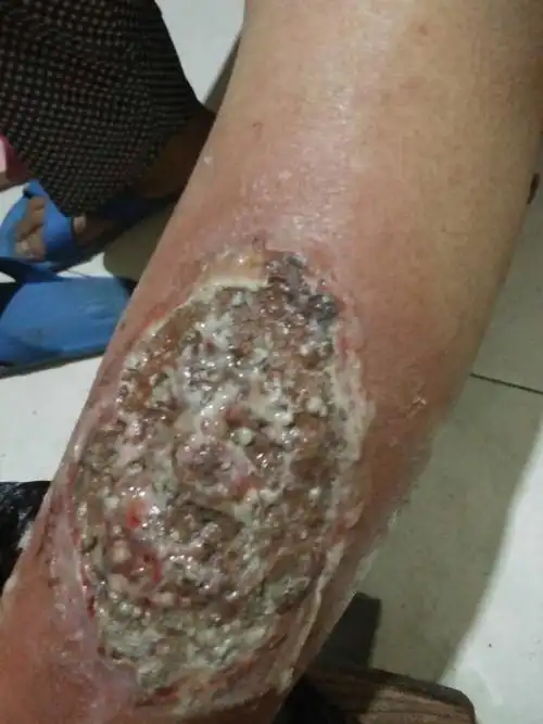 皮肤溃烂不知道原因求救!