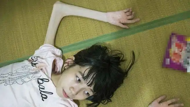 16岁少女因腹胀坚持"食疗",结果瘦的皮包骨头还营养不良!