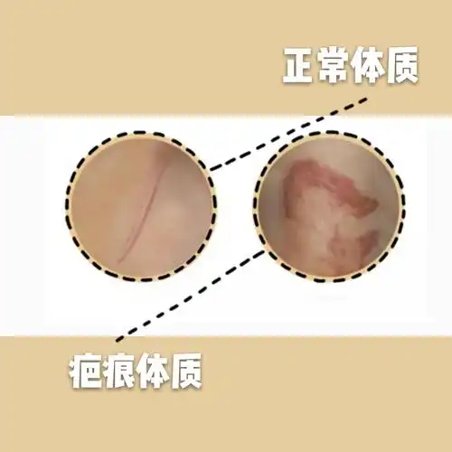 什么是疤痕体质