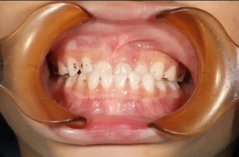 发现宝宝地包天什么时候矫正最合适