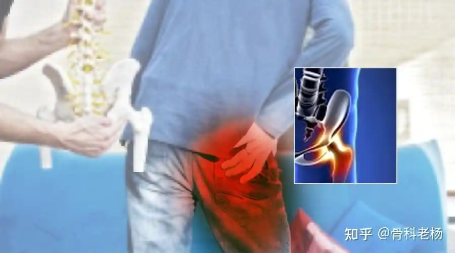 1,腹股沟疼痛(大腿根疼痛).