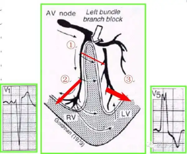 心电图课堂|第30期:完全左束支传导阻滞