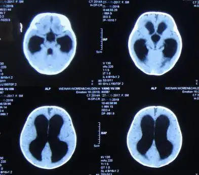 5个月婴儿脑积水出现头颅增大双眼落日征发育迟缓在脑脊液科获得早期