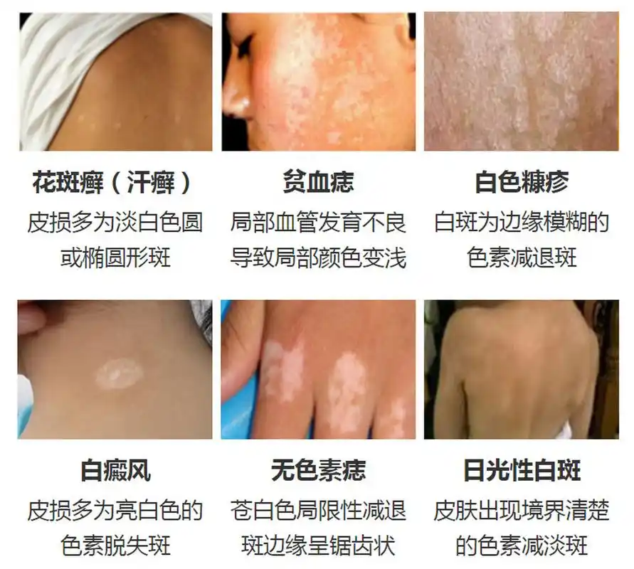 怎么区分是不是白癜风呢?