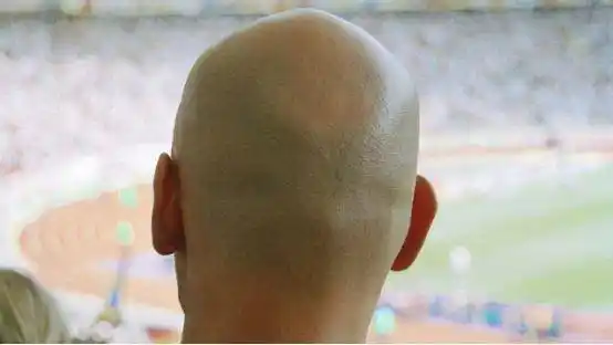 为什么有些人的后脑扁平?和3种原因有关,有1种要重视