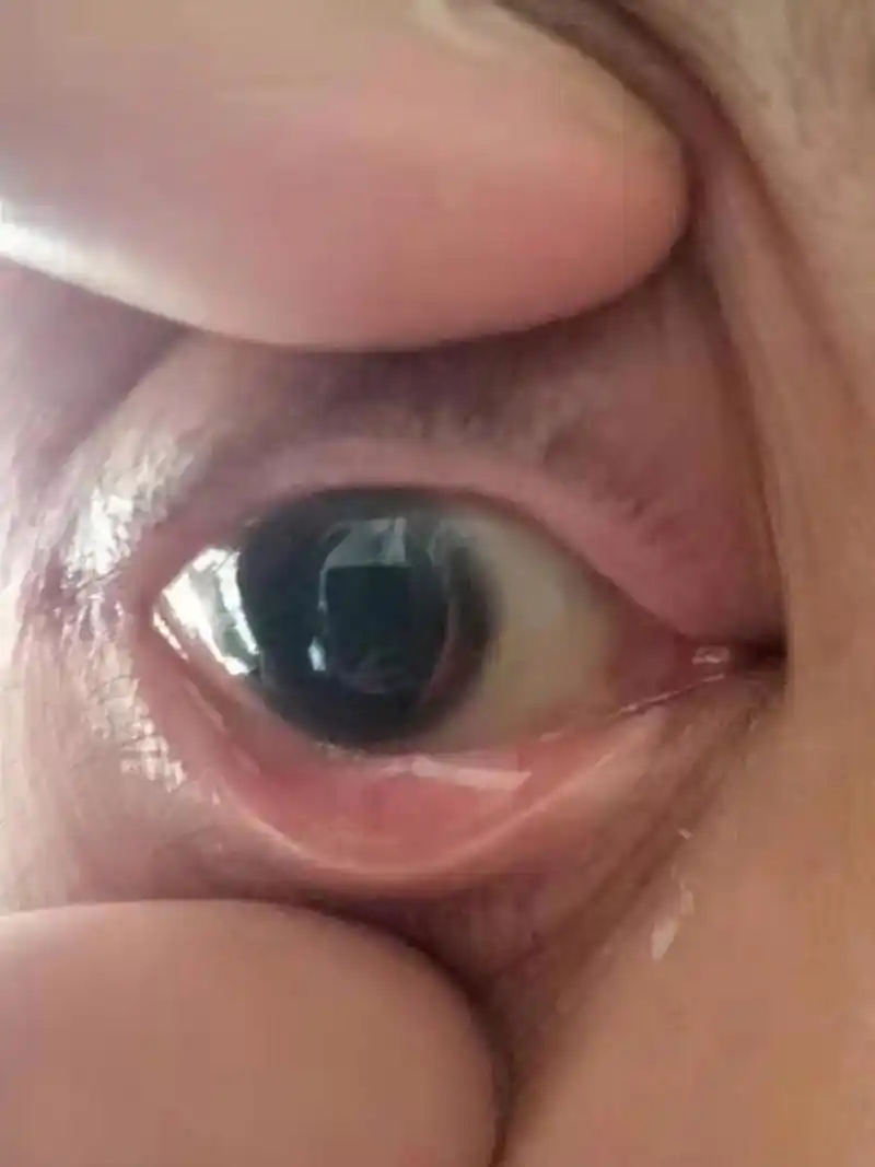 医生还给他散瞳,这已经两个星期多了,瞳孔还大的吓人