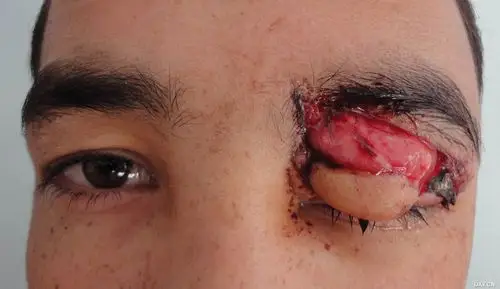 【病例讨论】罕见眼外伤. [病例帖]