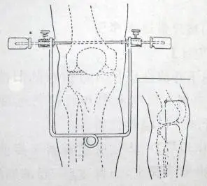 胫骨结节牵引【适应症】有移位股骨及骨盆环骨折,髋关节中心脱位及