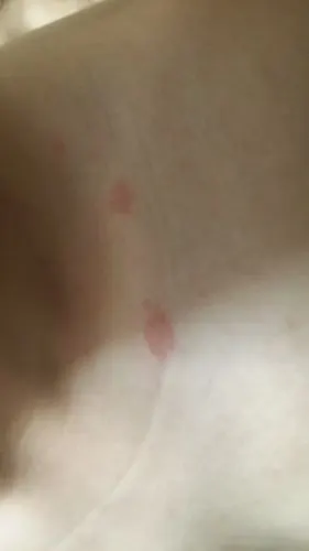 锁骨上起来一片红斑就像是水泡被挤过似的周围还有一处后肩