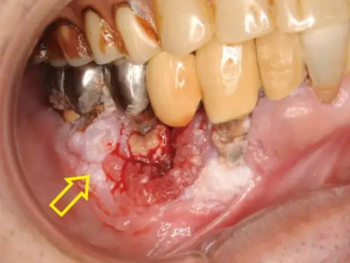 下颚歯肉がん