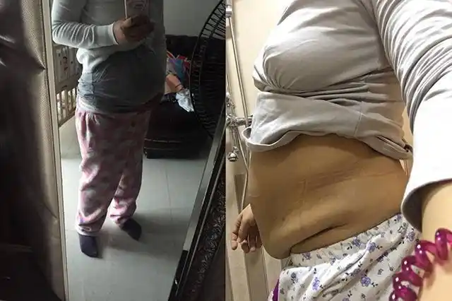 系统在静脉回流间拉大而失去了弹性,继而造成生产后的皮肤松弛现象