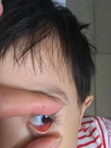 帮手看看霰粒肿这算是好了吗?