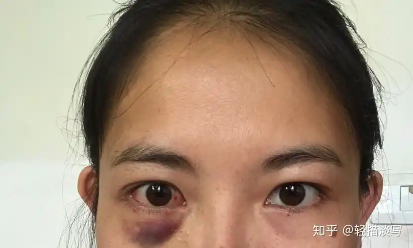 记录斜视手术的一天n - 知乎