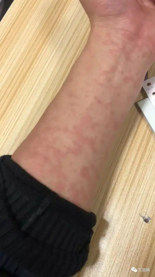 艾滋病皮疹是什么样的?|疱疹|皮肤病|感染_网易订阅