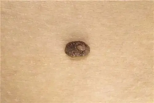 普通疣是小而硬的肿块,表面呈现椰菜花状,看起来很像黑刺一样.