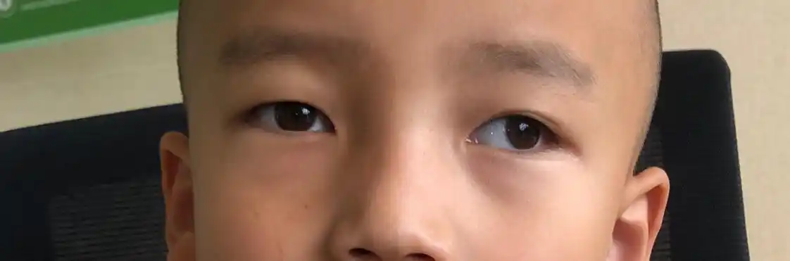 间歇性外斜您家孩子有吗家长关心的戳这里