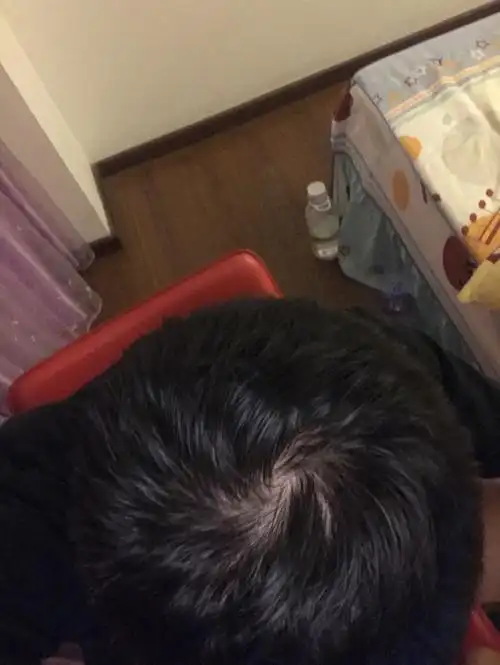 问一下我头顶这样算脱发吗?已经有点m字头了,才17岁